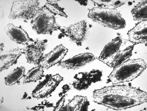  bone marrow … plasmocytoma (parafin-embedded sample)